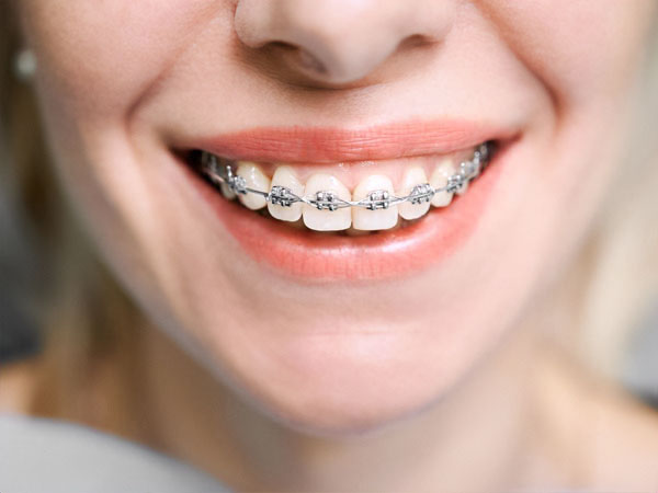 Ортодонтія в Smile Story